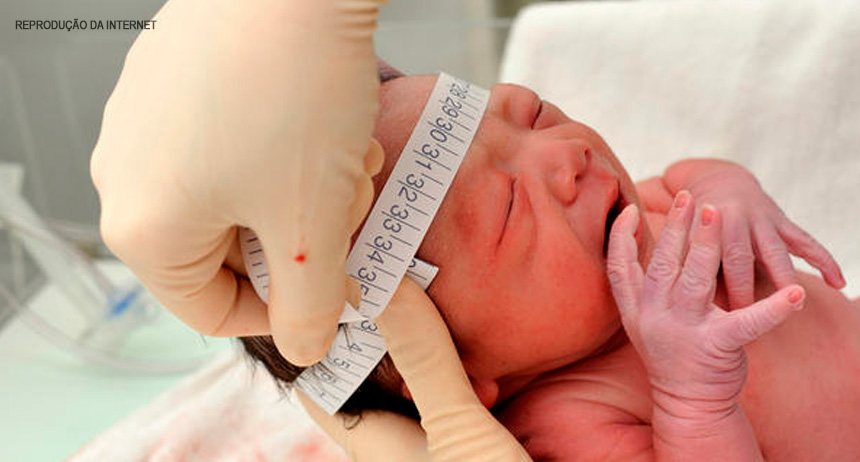 SES-DF: Microcefalia segue sob controle no DF