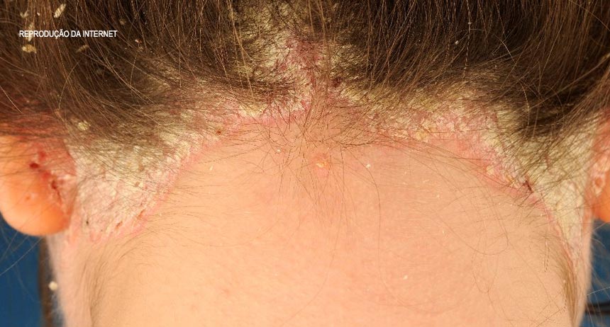 Psoríase Brasil lança Frente Parlamentar no Congresso Nacional em Campanha do Dia Mundial 2017