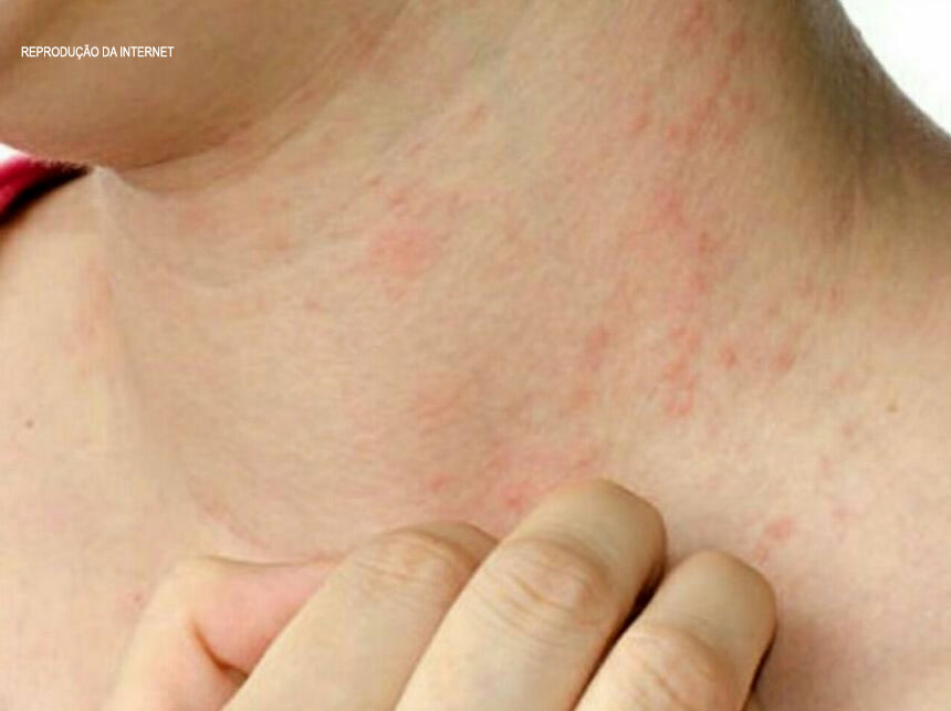 Esclerose múltipla e psoríase entram em pauta no Senado: especialistas discutem novas tecnologias e medicações no tratamento das doenças autoimunes