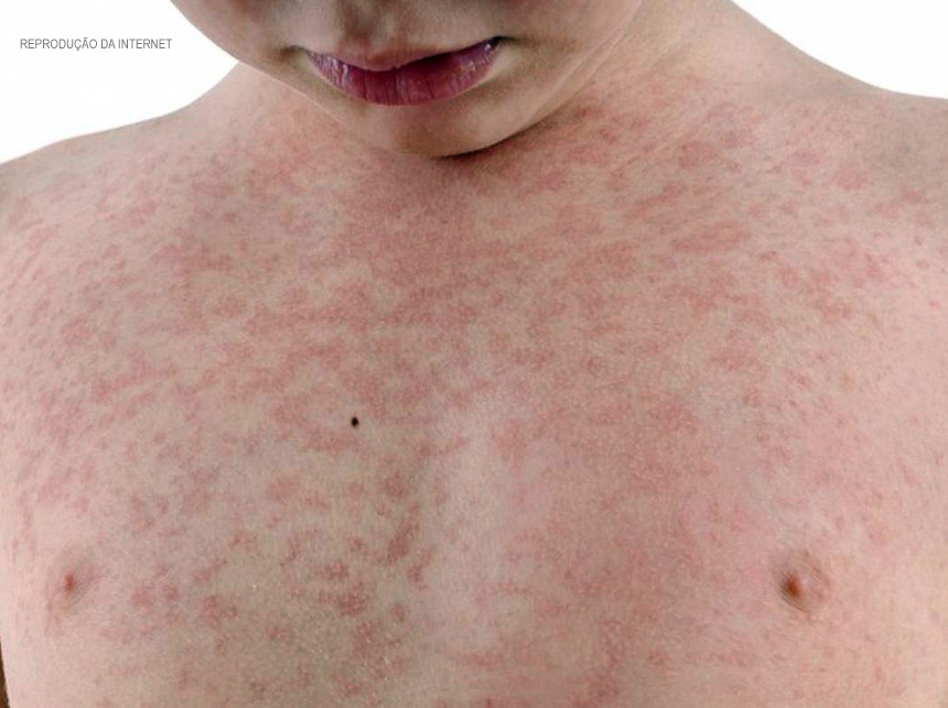 Secretaria de Saúde descarta dois casos suspeitos de sarampo no DF