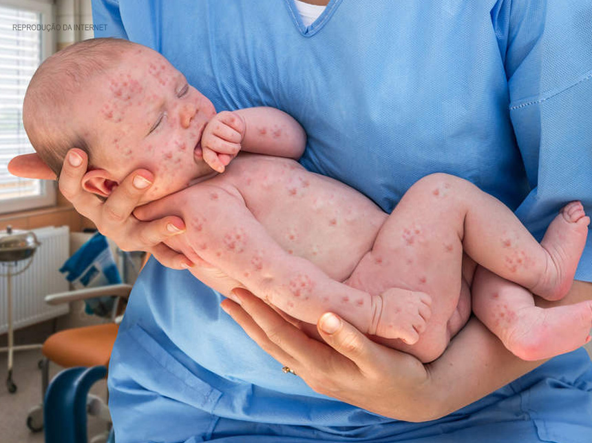 Sarampo: entenda os sintomas, riscos e tratamento