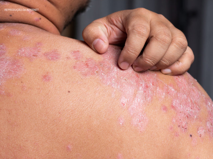 SUS oferece mais quatro medicamentos para tratar psoríase