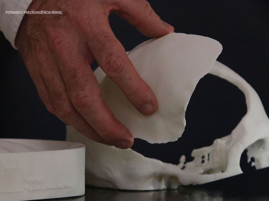 Brasileiros desenvolvem tecnologia de reconstrução craniana