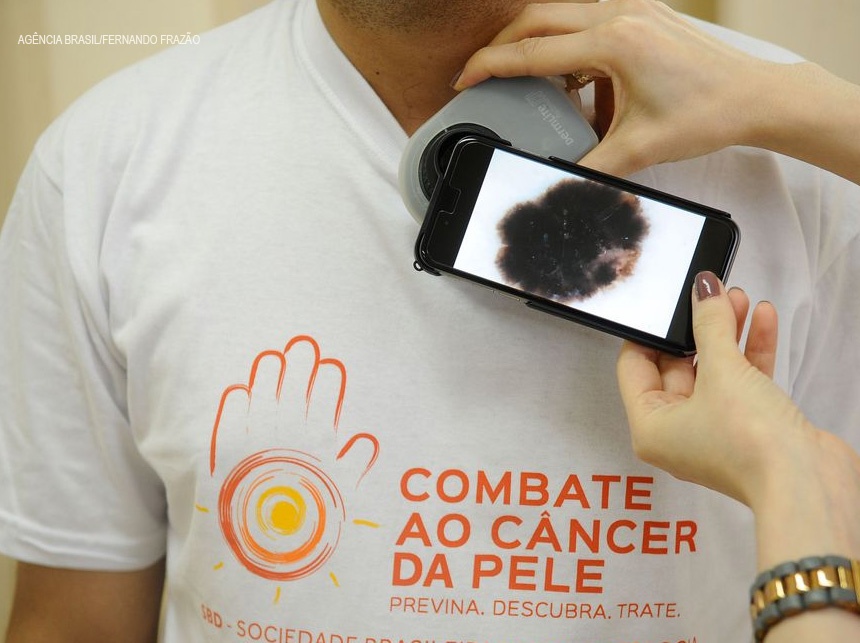 Câncer de pele: Pesquisadores desenvolvem software para diagnosticar melanoma