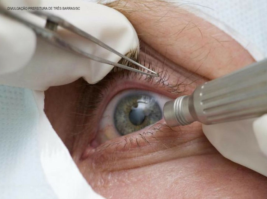 Número de operações de catarata dobrou no Brasil em dez anos