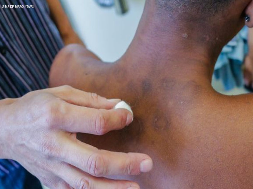 SUS disponibiliza novo tratamento para hanseníase