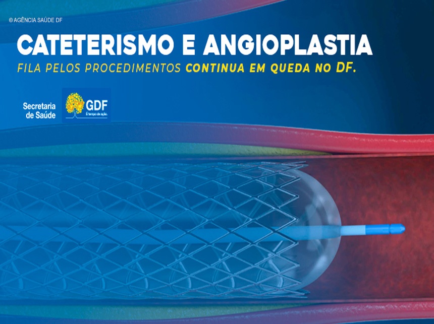 Saúde do DF zera demanda reprimida por angioplastias e cateterismos de 2020