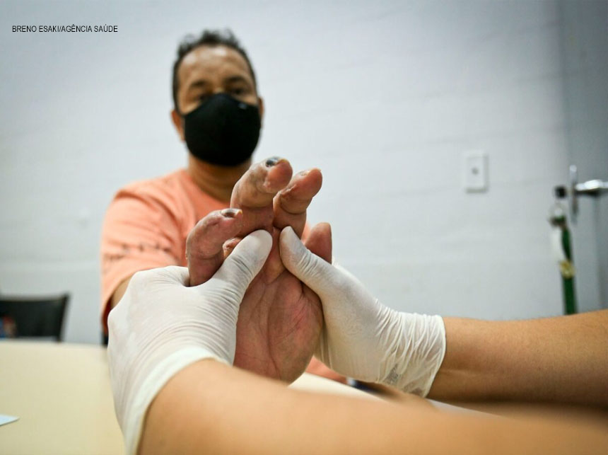 Rede pública tem ambulatórios especializados em terapia da mão