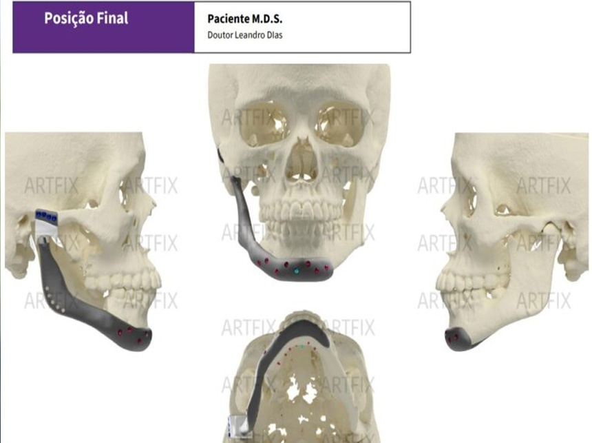 Hospital de Sobradinho faz cirurgia de substituição total da articulação temporomandibular