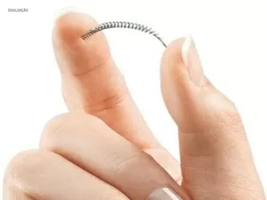Paciente tem direito de remover Essure pelo SUS, independente de provar defeito