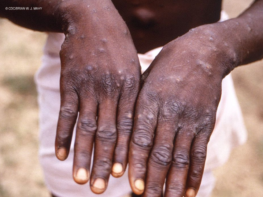 Rio registra segunda morte de infectado pela varíola dos macacos