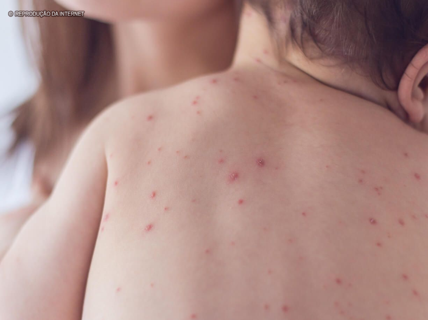 EUA registram primeiros casos de varíola dos macacos em crianças