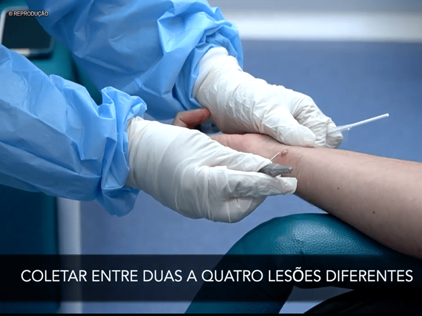 Lacens do país devem ser capacitados a diagnosticar monkeypox até final de agosto