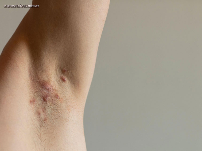 Saiba o que é a hidradenite supurativa e quais os fatores de risco