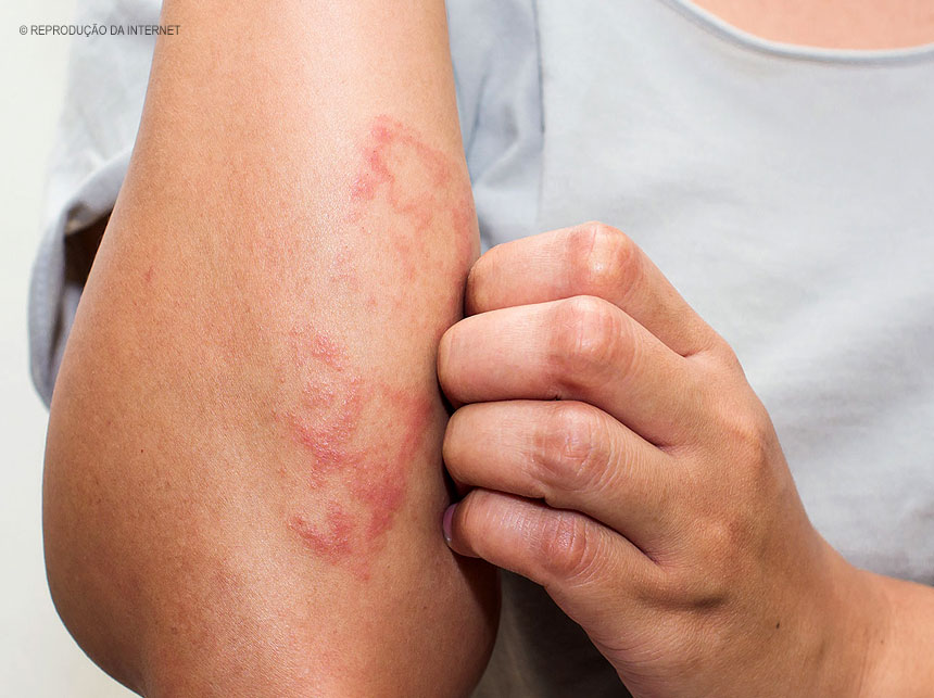 Por decisão da Justiça, servidores federais ficam proibidos de usar termo ‘lepra’ para se referir a hanseníase