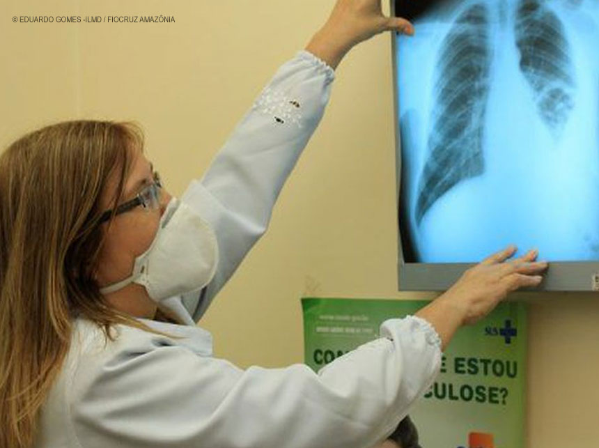 Conselho aprova novas diretrizes para tratamento da tuberculose no SUS