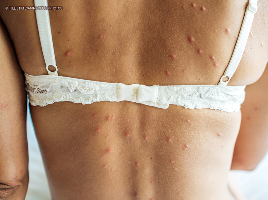 Morte de brasileiro acende alerta sobre a catapora