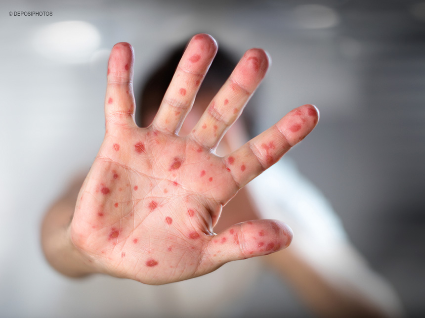 Febre Amarela, catapora, sarampo, caxumba e rubéola ressurgem depois de anos sem registros