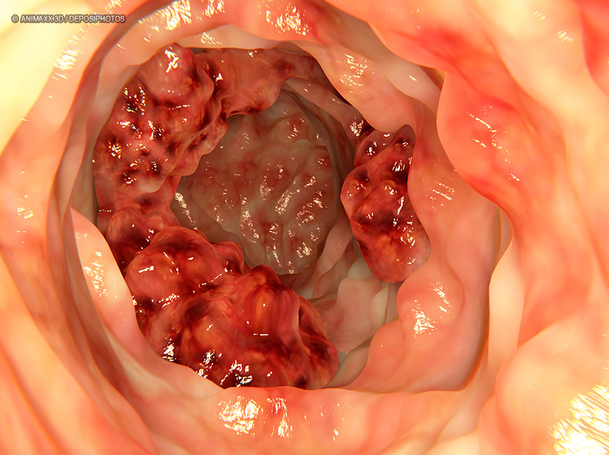 Exames aumentam as chances de cura do câncer de intestino