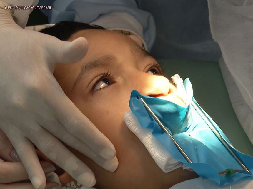 Genética e inflamação na gravidez explicam lábio leporino