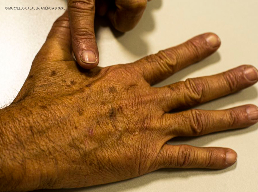 Tecnologia para tratar câncer de pele é aprovada para uso no SUS