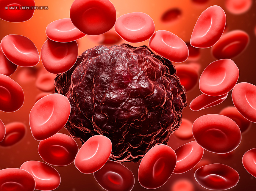 Anvisa autoriza pesquisa em pacientes com leucemia linfoide aguda B
