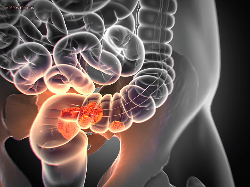 América Latina: mortes por câncer colorretal crescem 20,5% em 30 anos
