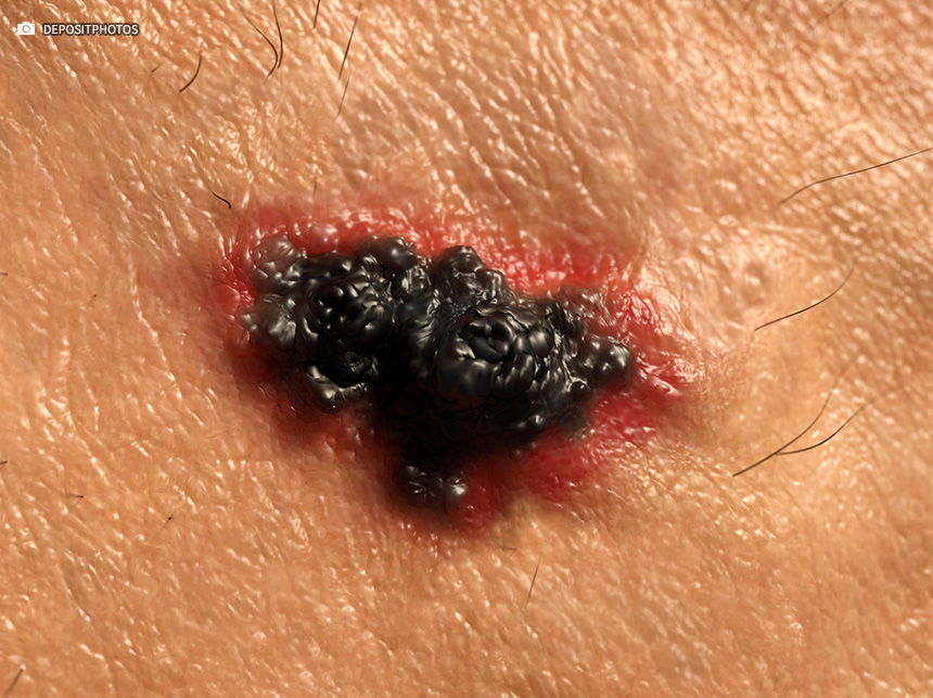 1 em cada 10 casos de melanoma ocorrem em pessoas que herdaram mutação genética