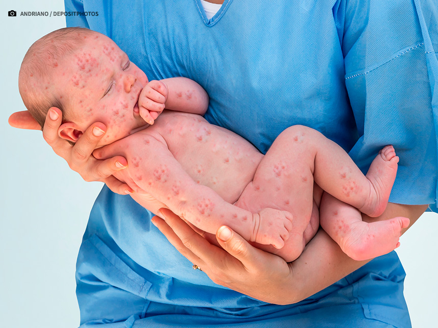 OMS alerta para aumento de casos de sarampo no mundo