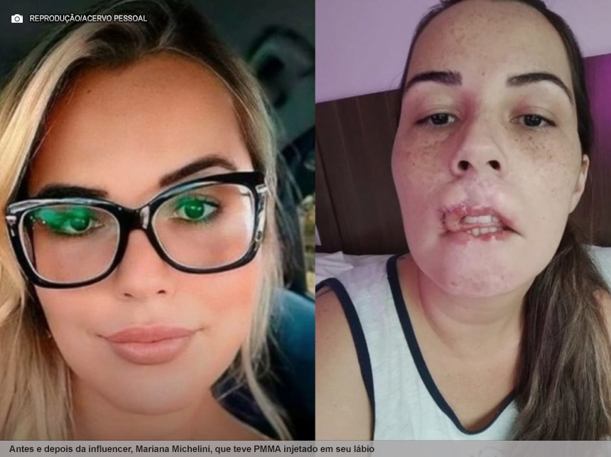 Entenda o que é PMMA e os riscos do uso em procedimentos estéticos