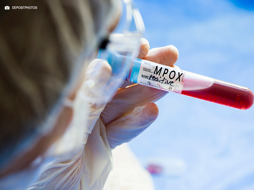 Brasil contabiliza 1,5 mil casos de mpox em 2024