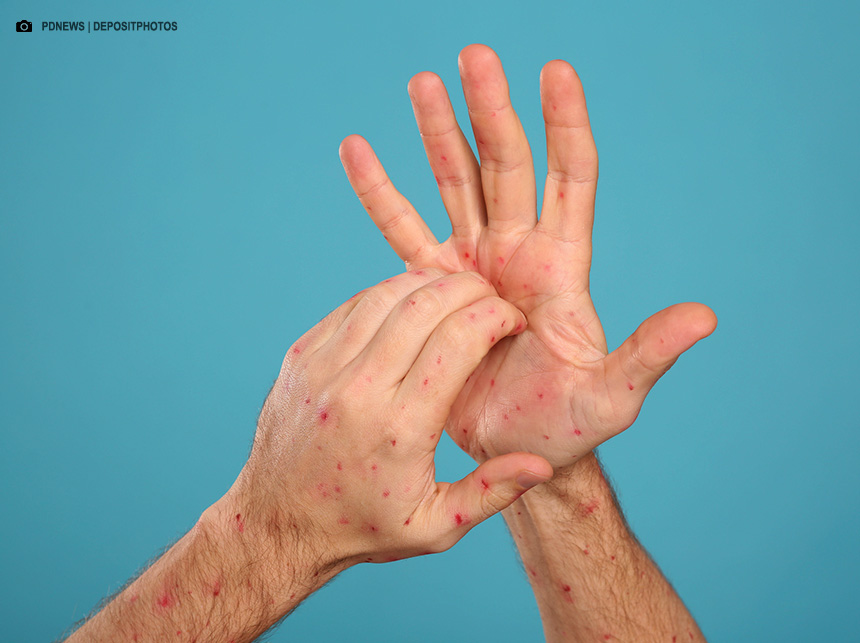 Mpox: conheça sintomas e tire principais dúvidas sobre a doença