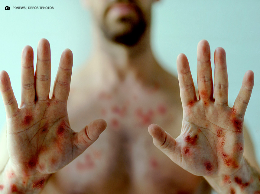 Casos de MPOX se aproximam de 100 mil em todo o mundo, alerta OMS