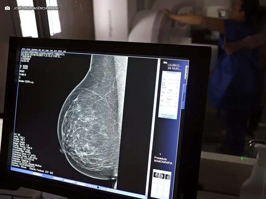 Cerca de 77 mil mulheres aguardam mamografia pelo SUS