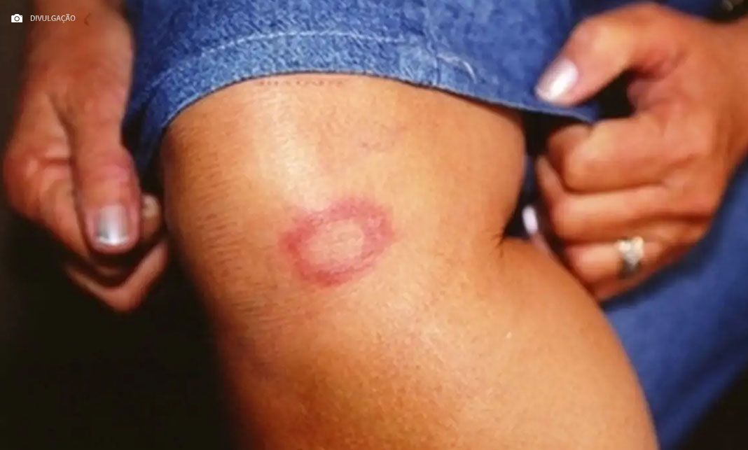 Hanseníase: conheça verdades e mitos sobre a doença