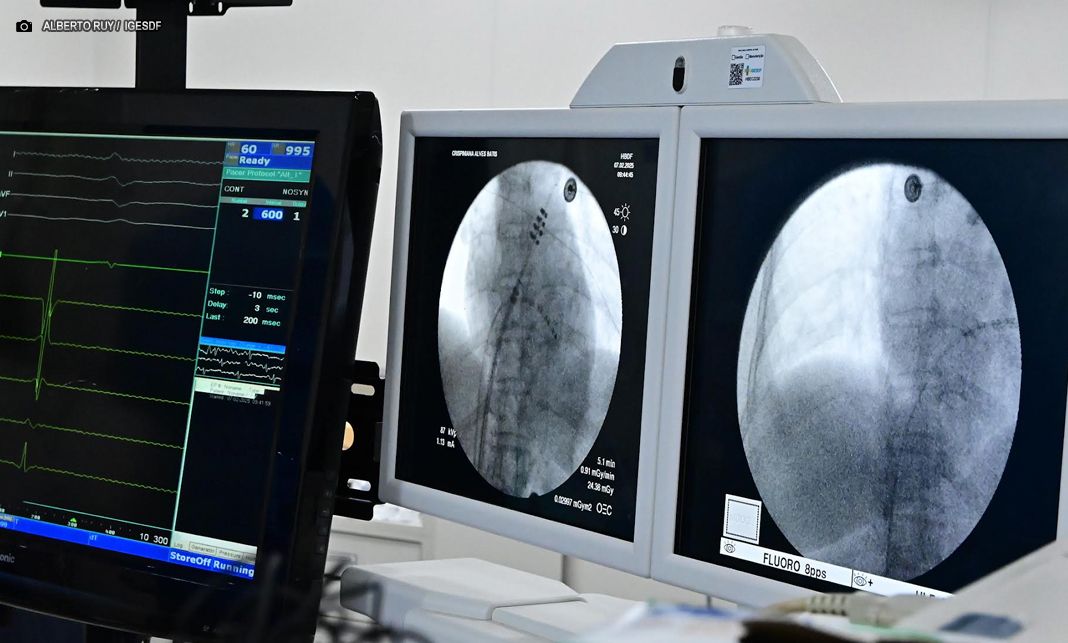 Hospital de Base do DF é a primeira unidade 100% SUS a realizar intervenção cardíaca minimamente invasiva