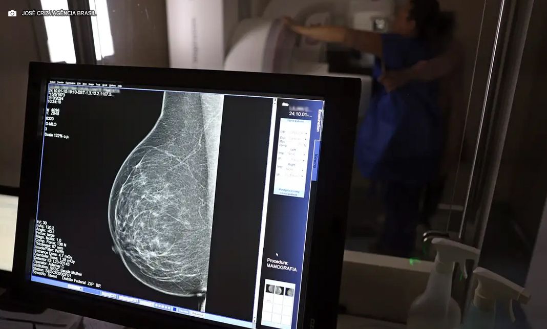 Periodicidade de mamografias divide médicos e autoridades de saúde