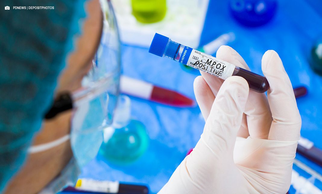 Saúde confirma primeiro caso de nova cepa de mpox no Brasil