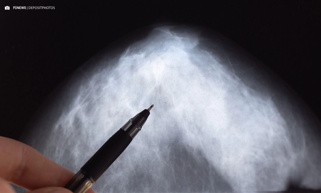 ANS, FEMAMA e entidades médicas elaboram documento que prevê o rastreio do câncer de mama em mulheres na faixa dos 40 a 74 anos na saúde suplementar