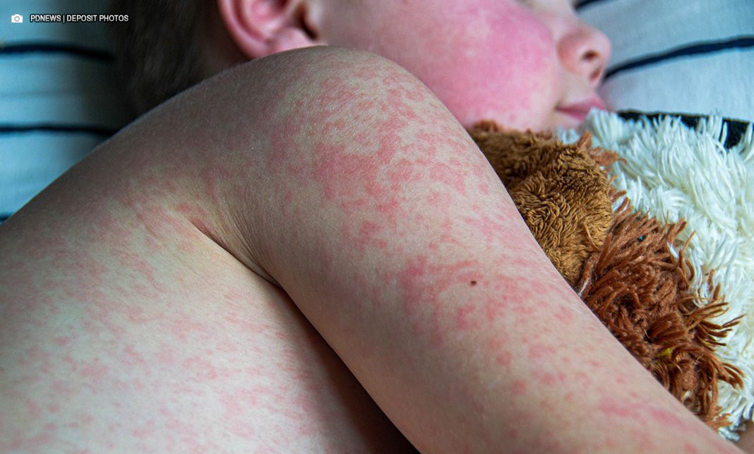 Distrito Federal reporta primeiro caso de sarampo