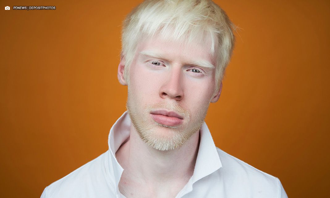 Saúde oferta tratamento multiprofissional para pacientes com albinismo