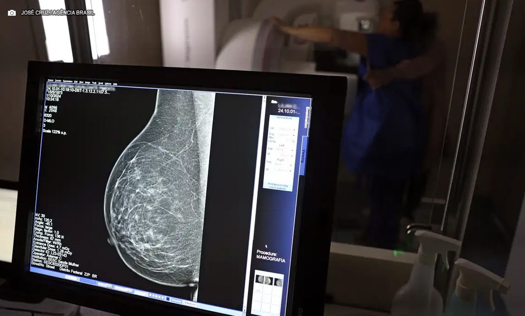 Câncer de mama: uma em cada três pacientes tem menos de 50 anos