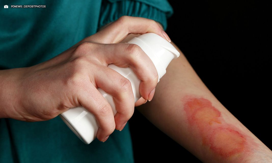 Violência contra Mulher é tema de campanha de prevenção a queimaduras