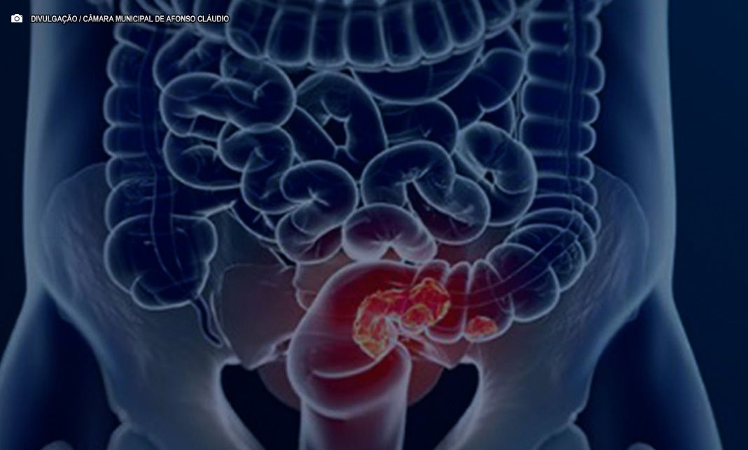 Estudo projeta aumento de 36% em mortes por câncer colorretal até 2040