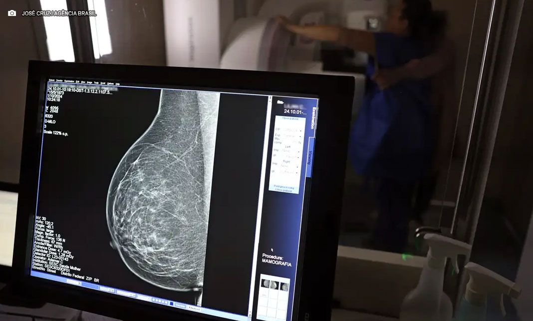 SUS amplia acesso a mamografia e passa a recomendar exame a partir dos 40 anos