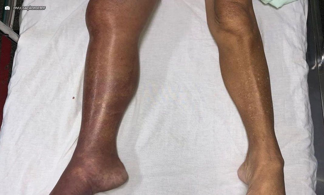 Especialista alerta sobre riscos e prevenção da trombose