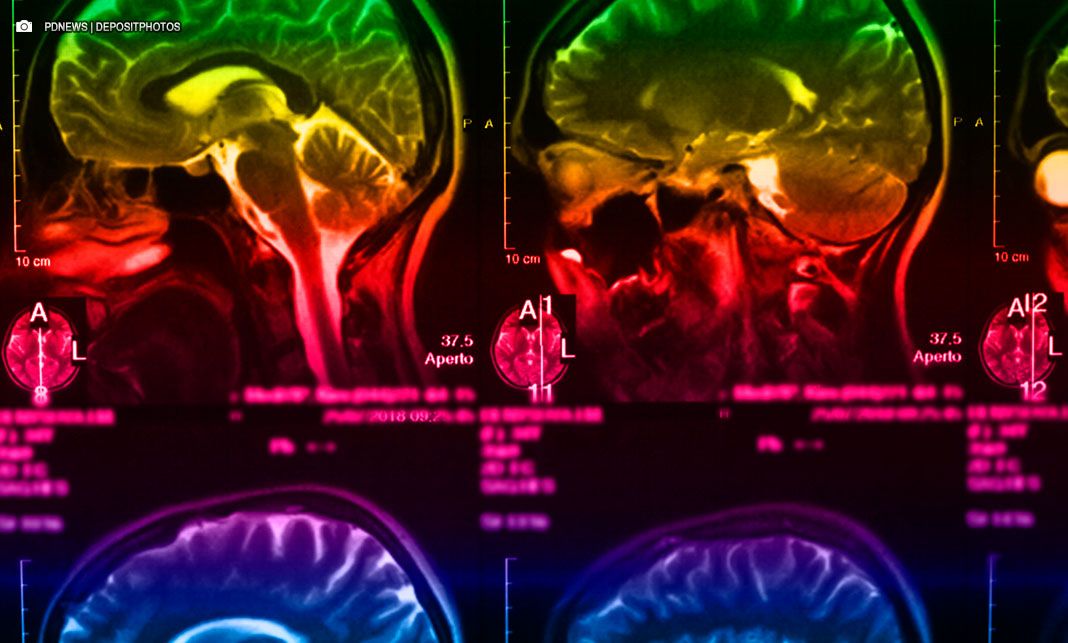 Pesquisas brasileiras avançam no diagnóstico de Alzheimer