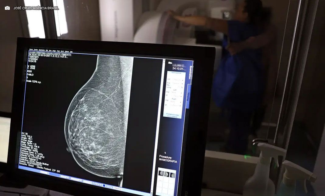 Saúde passa a recomendar mamografia a partir dos 40 anos no SUS