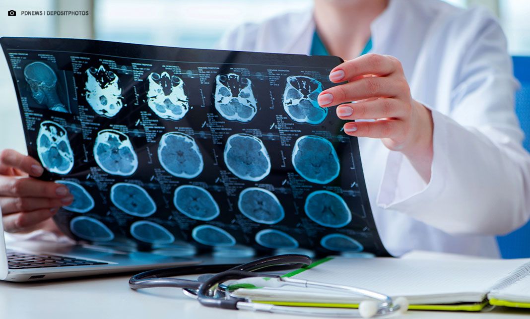 Inflamação no cérebro deve ser chave para progressão do Alzheimer, aponta estudo brasileiro