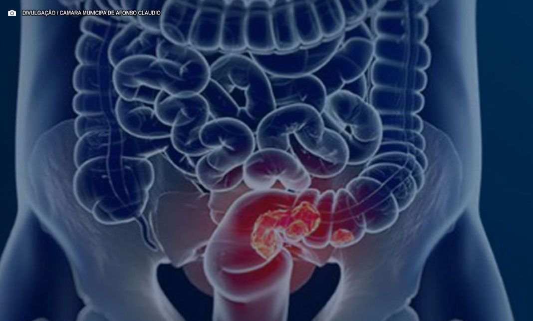 Pacientes com câncer colorretal são diagnosticados em estágio avançado